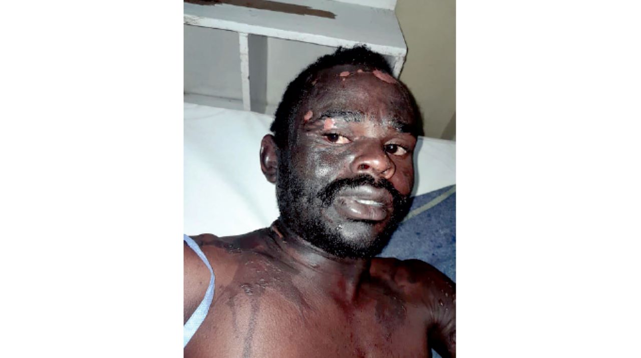 You are currently viewing Horror as Bulawayo Woman Scalds Sleeping Boyfriend With Boiling Cooking Oil